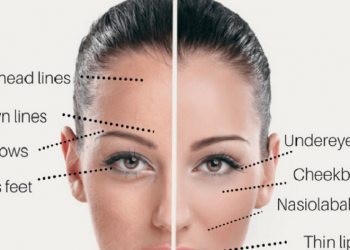 best botox